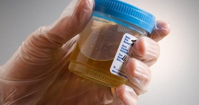 Šta znači kad vam je urin plav, a šta kad je boje meda: Sve što trebate znati o svojoj mokraći