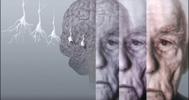 Otkriveni rani simptomi Alzheimerove bolesti kod mlađih ljudi: A kako vi navigirate?