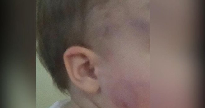 Vaspitačica i direktorica zaradile prijavu zbog 30 modrica i odgrizenog dijela uha na tijelu bebe