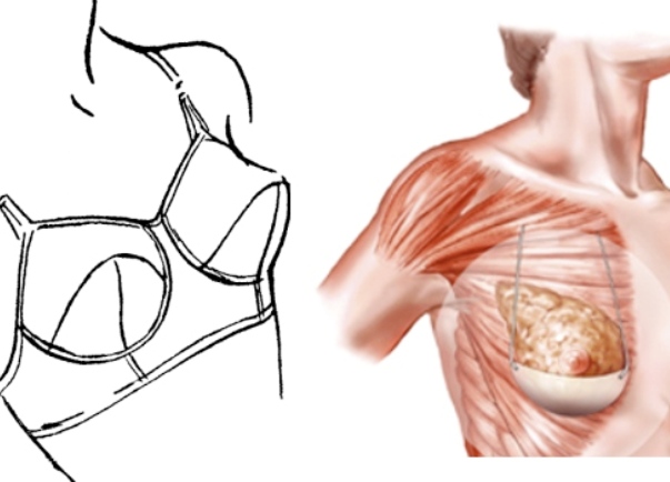 nevidljivi grudnjak nevidljivi grudnjak