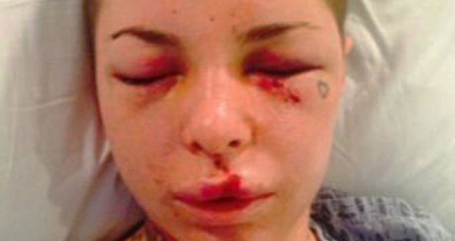 MMA borac brutalno pretukao porno zvijezdu: Slomio joj nos i 18 kostiju oko očiju, nožem ošišao kosu, izbio zube...