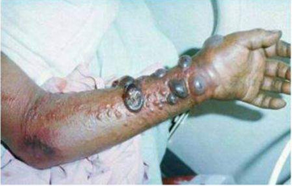 ebola3