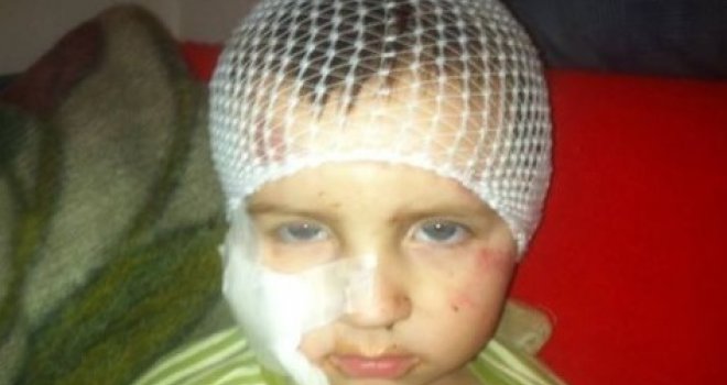Agresivni pas izgrizao 3-godišnjaka: Dijete ima 13 šavova po sebi i ne prestaje plakati od šoka