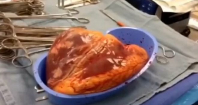 Srce na kokainu: Nastavilo kucati 25 minuta nakon što je izvađeno iz tijela donora