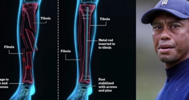 Prikaz noge Tigera Woodsa ne sluti na dobro, hirurg ne može tvrditi da će opet moći igrati golf
