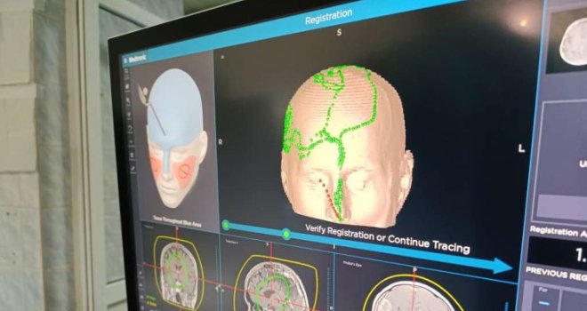 Zenički neurohirurzi obavili prvu operaciju tumora mozga uz upotrebu uređaja za neuronavigaciju