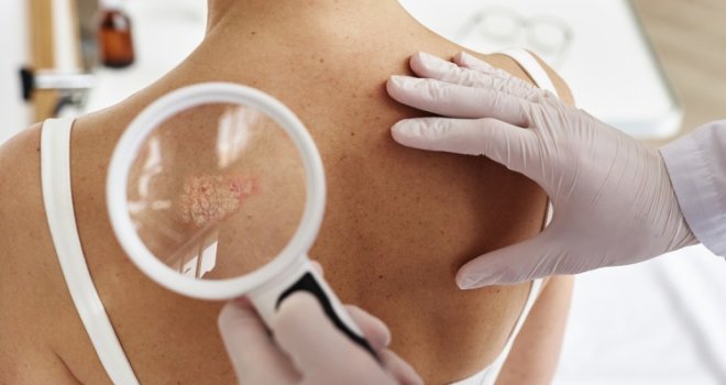 Mnogi je doživljavaju samo kao estetski problem… Pogrešno! Psorijaza je više od kože!