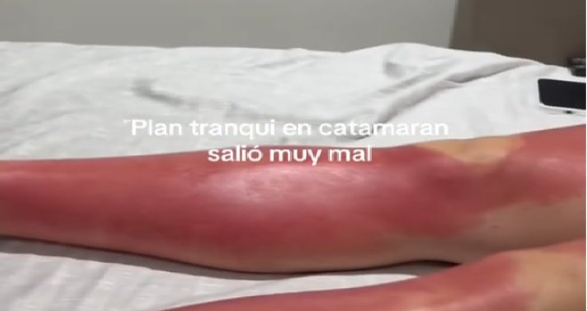 Mirno se sunčala na katamaranu i uživala, ubrzo završila u Hitnoj, dugo će pamtiti ovo...